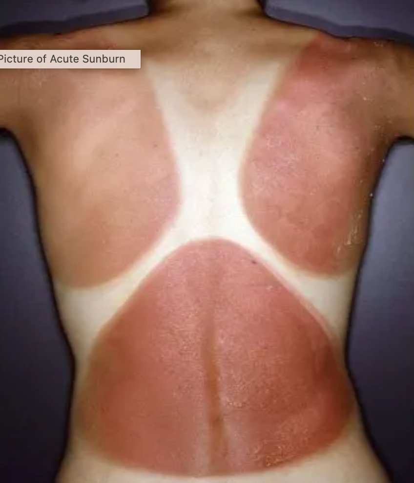 Sunburned? I Was a Doctor for 40 Years, Here's What You NEED to Know