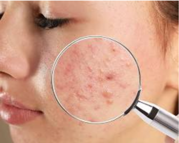 A Gynecologist/Cosmetic Surgeon Tells Why Your Acne Medicine Is Not Working; And How To Fix It!