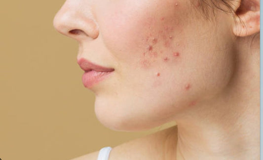 Hormonal Acne: Best Ways To Conquer It - Bare Skin Care by Dr. Bollmann