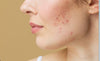 Hormonal Acne: Best Ways To Conquer It