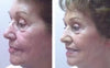 Can Laser Skin Resurfacing Improve A Person's Looks